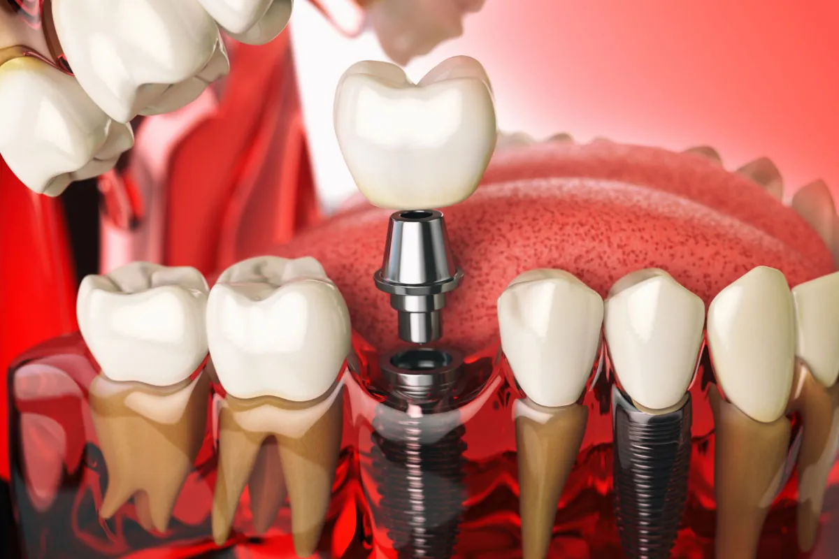 digital model showing how dental implants are placed