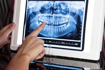 3D digital x-ray used at Rugby Dental Arts to better diagnose oral health